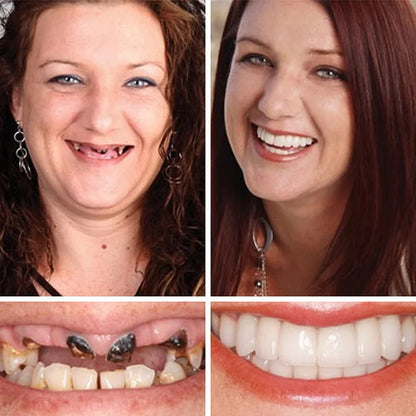 🌎Ends Today: 70% OFF! ⏰ Medical Full Denture with Strong Suctiond